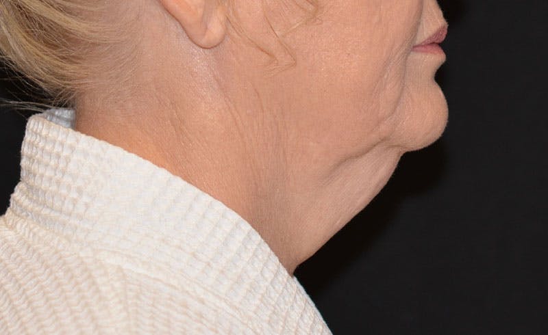 Female Double Chin Before & After Gallery - Patient 352763 - Image 1