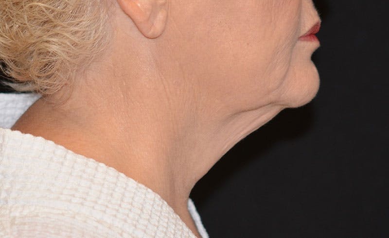 Female Double Chin Before & After Gallery - Patient 352763 - Image 2