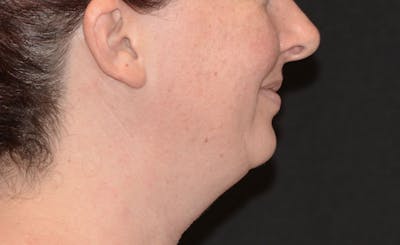 Female Double Chin Before & After Gallery - Patient 952823 - Image 1