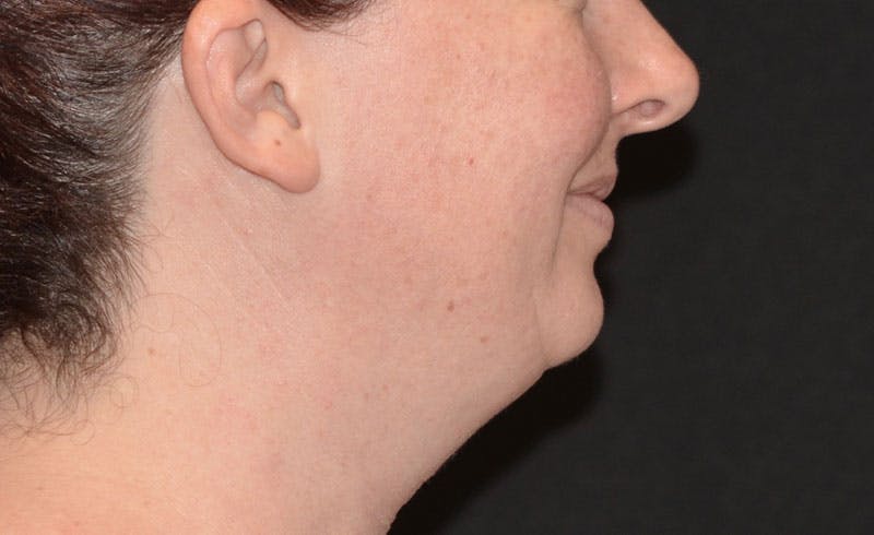 Female Double Chin Before & After Gallery - Patient 952823 - Image 1