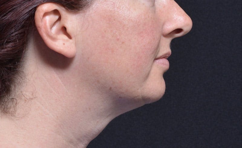 Female Double Chin Before & After Gallery - Patient 952823 - Image 2