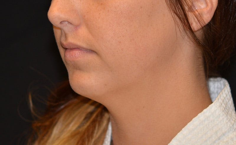 Female Double Chin Before & After Gallery - Patient 224588 - Image 1