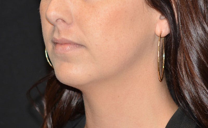 Female Double Chin Before & After Gallery - Patient 224588 - Image 2