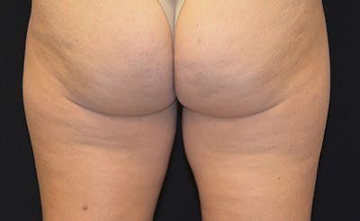 Female Inner Thighs Before & After Gallery - Patient 212803 - Image 1