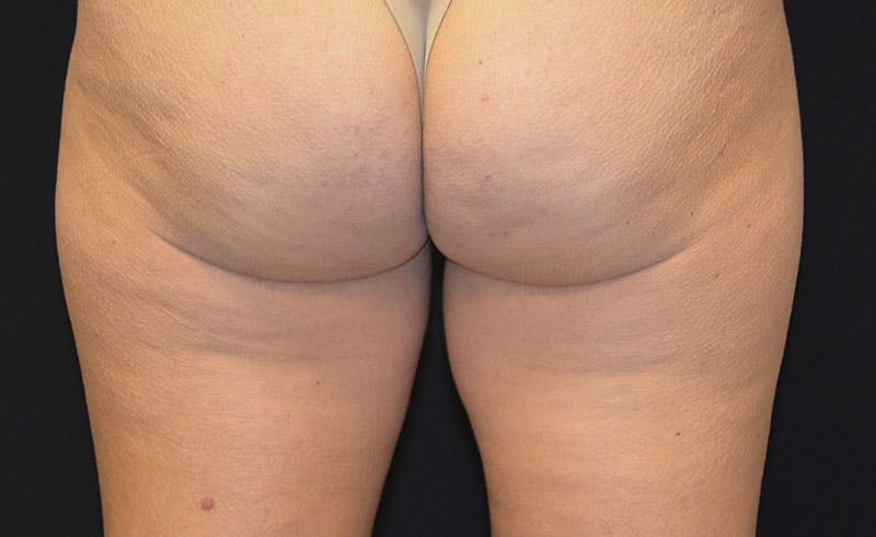Female Inner Thighs Before & After Gallery - Patient 212803 - Image 1