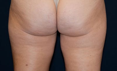 Female Inner Thighs Before & After Gallery - Patient 212803 - Image 2