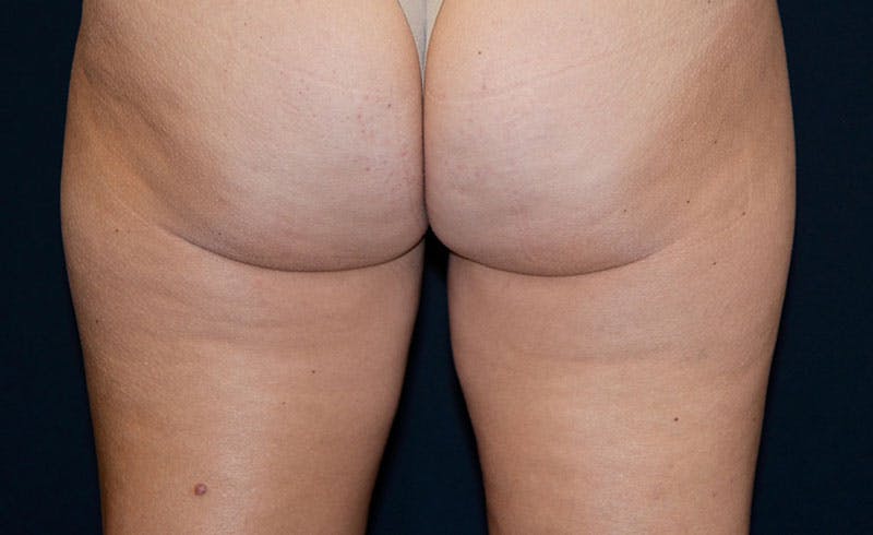 Female Inner Thighs Before & After Gallery - Patient 212803 - Image 2