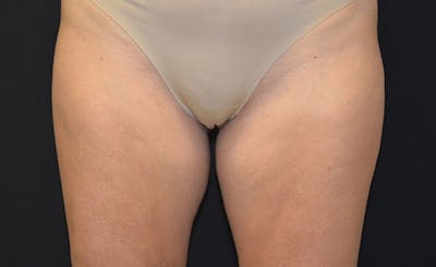Female Inner Thighs Before & After Gallery - Patient 189216 - Image 1