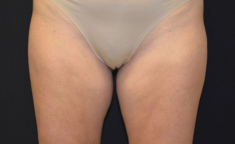 Female Inner Thighs Before & After Gallery - Patient 189216 - Image 1