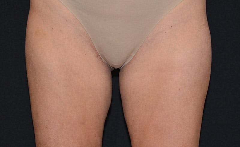 Female Inner Thighs Before & After Gallery - Patient 189216 - Image 2
