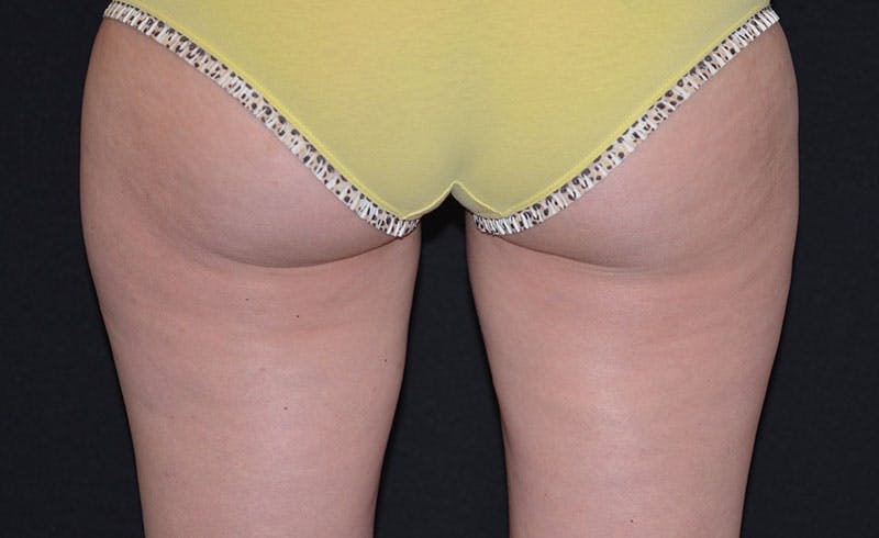 Female Inner Thighs Before & After Gallery - Patient 150320 - Image 2