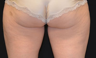 Female Inner Thighs Before & After Gallery - Patient 418200 - Image 1