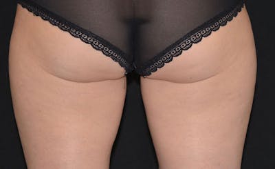 Female Inner Thighs Before & After Gallery - Patient 418200 - Image 2