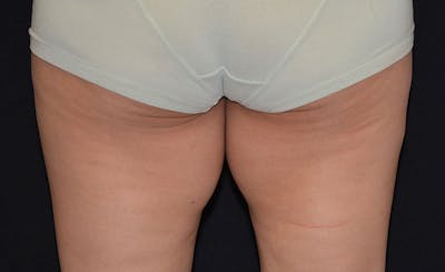 Female Inner Thighs Before & After Gallery - Patient 169829 - Image 1