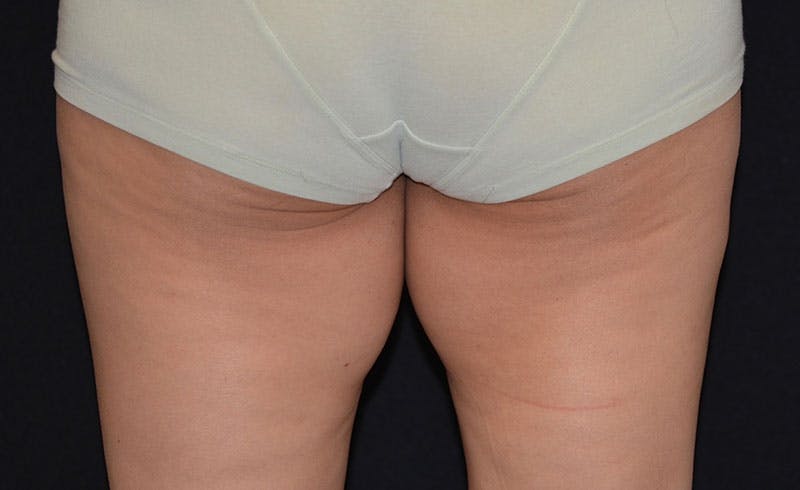 Female Inner Thighs Before & After Gallery - Patient 169829 - Image 1