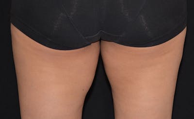 Female Inner Thighs Before & After Gallery - Patient 169829 - Image 2