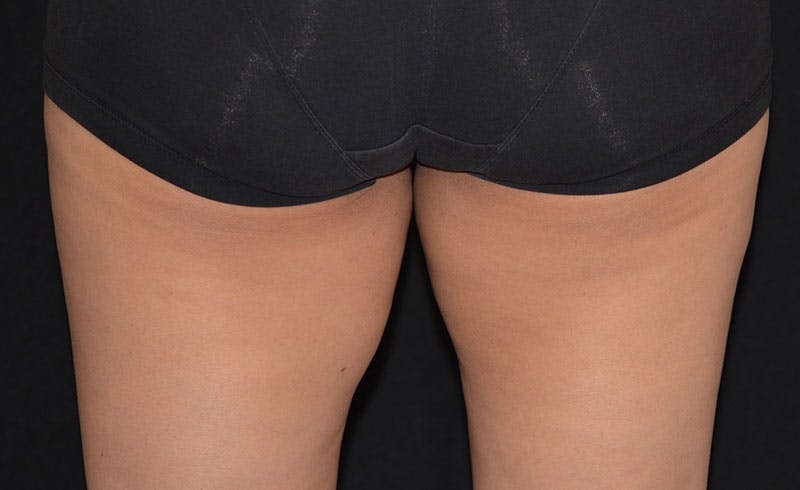 Female Inner Thighs Before & After Gallery - Patient 169829 - Image 2