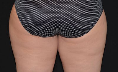 Female Inner Thighs Before & After Gallery - Patient 275701 - Image 1