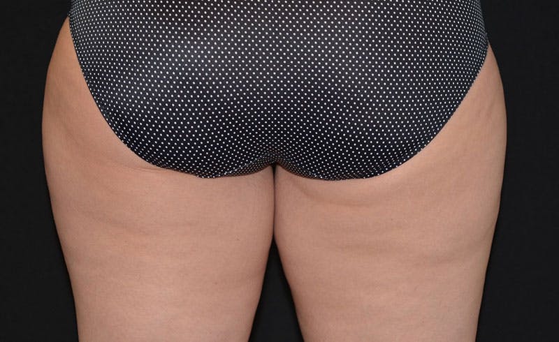 Female Inner Thighs Before & After Gallery - Patient 275701 - Image 1