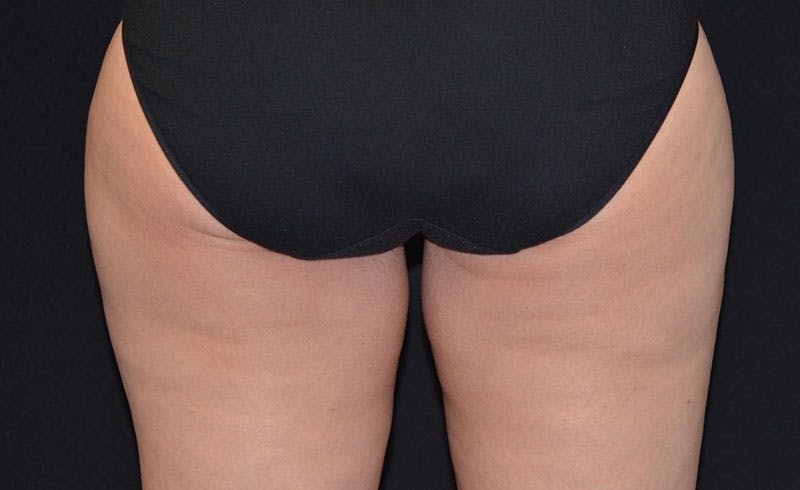 Female Inner Thighs Before & After Gallery - Patient 275701 - Image 2