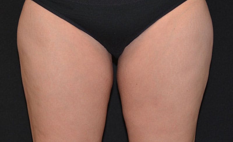 Female Inner Thighs Before & After Gallery - Patient 140361 - Image 2
