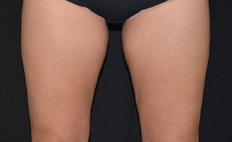 Female Inner Thighs Before & After Gallery - Patient 835313 - Image 2