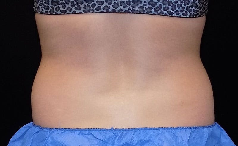 Female Love Handles Before & After Gallery - Patient 183804 - Image 1