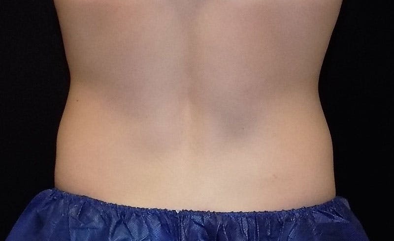 Female Love Handles Before & After Gallery - Patient 183804 - Image 2