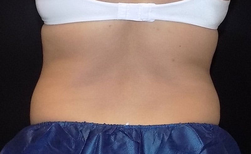 Female Love Handles Before & After Gallery - Patient 184376 - Image 1