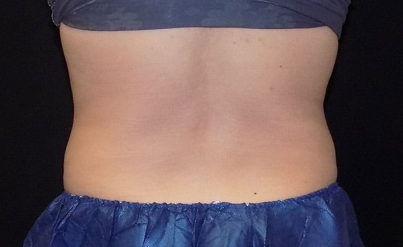 Female Love Handles Before & After Gallery - Patient 184376 - Image 2
