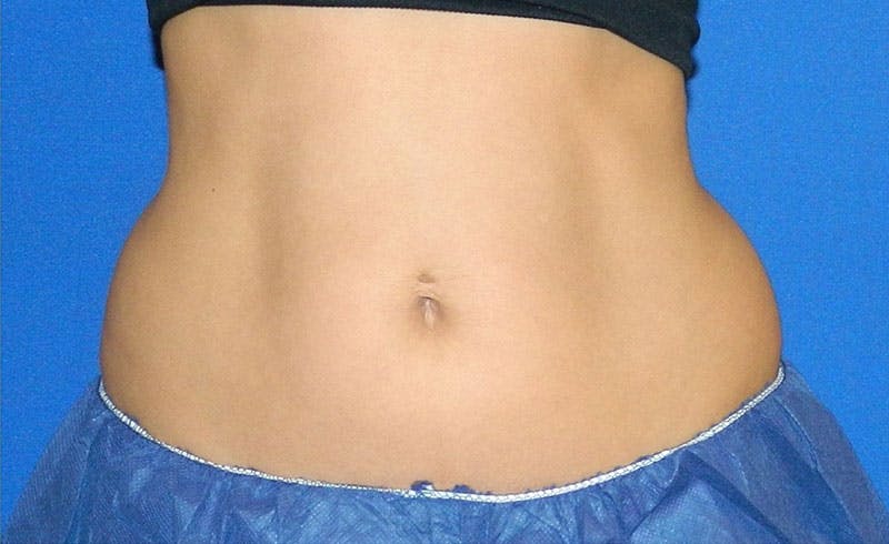 Female Love Handles Before & After Gallery - Patient 124221 - Image 1