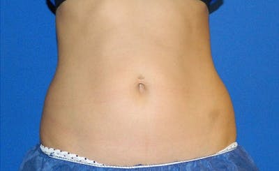 Female Love Handles Before & After Gallery - Patient 124221 - Image 2