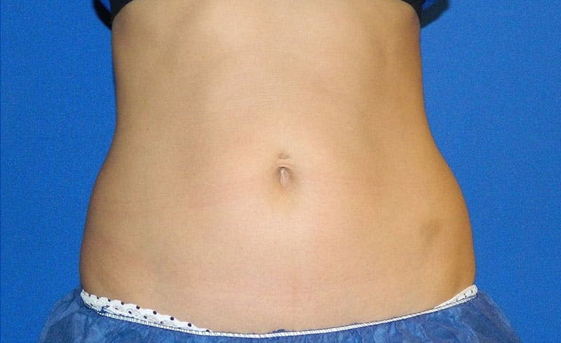 Female Love Handles Before & After Gallery - Patient 124221 - Image 2