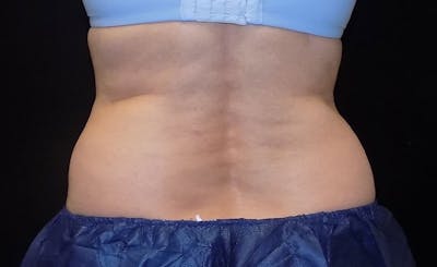 Female Love Handles Before & After Gallery - Patient 166068 - Image 1