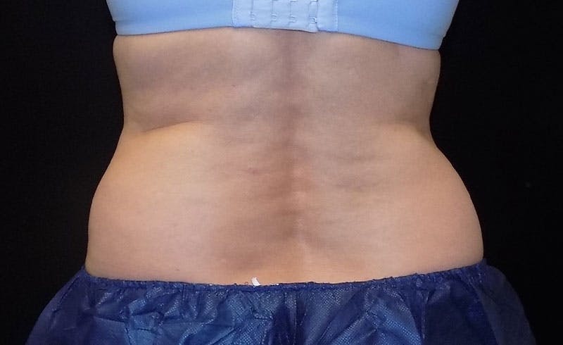 Female Love Handles Before & After Gallery - Patient 166068 - Image 1