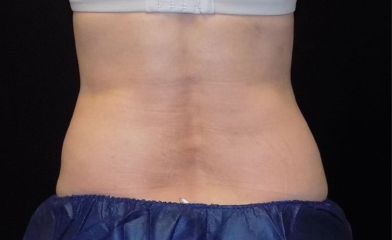 Female Love Handles Before & After Gallery - Patient 166068 - Image 2