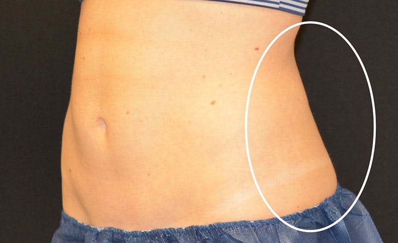 Female Love Handles Before & After Gallery - Patient 217166 - Image 1