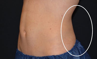 Female Love Handles Before & After Gallery - Patient 217166 - Image 2