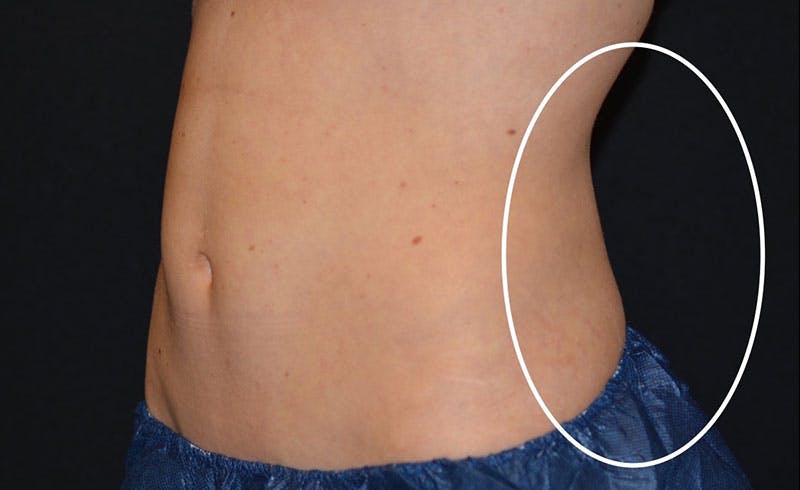 Female Love Handles Before & After Gallery - Patient 217166 - Image 2