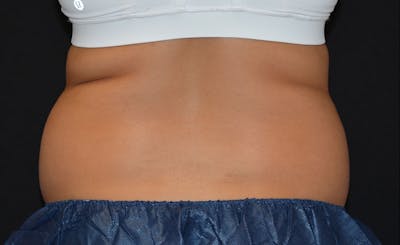 Female Love Handles Before & After Gallery - Patient 362601 - Image 1