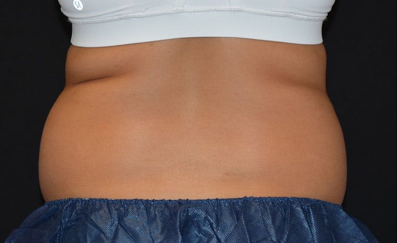 Female Love Handles Before & After Gallery - Patient 362601 - Image 1