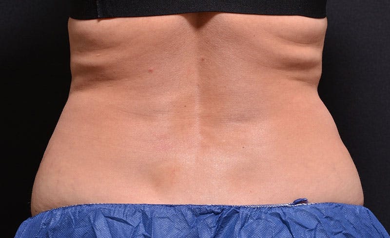 Female Love Handles Before & After Gallery - Patient 213377 - Image 1