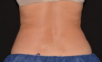 Female Love Handles Before & After Gallery - Patient 213377 - Image 2