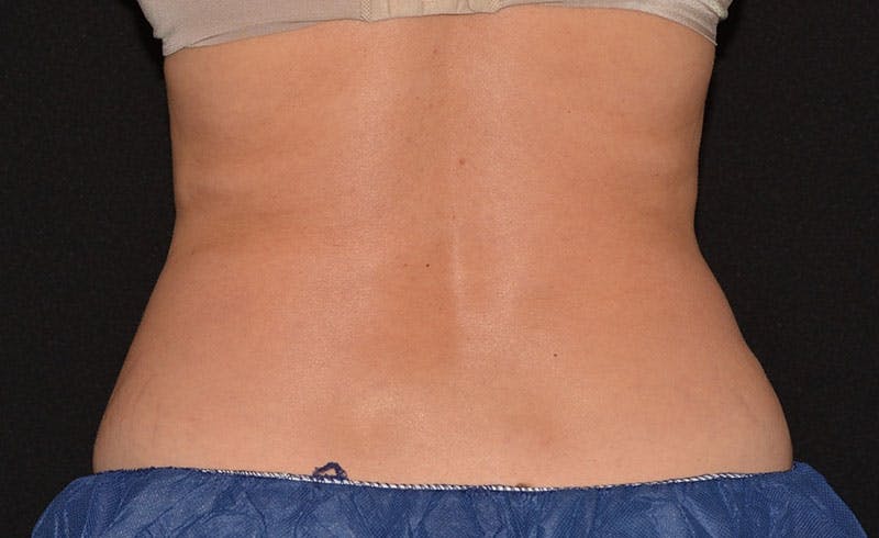 Female Love Handles Before & After Gallery - Patient 213377 - Image 2