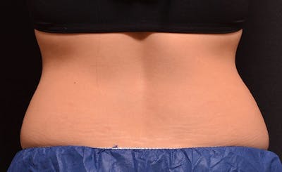 Female Love Handles Before & After Gallery - Patient 366564 - Image 1