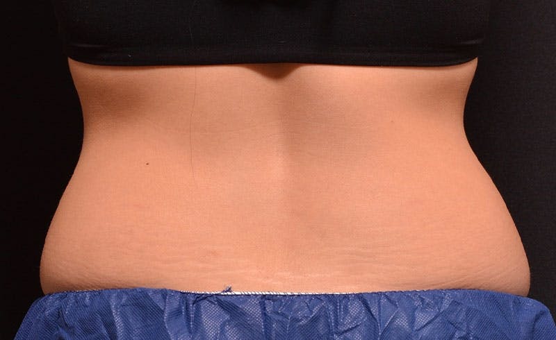 Female Love Handles Before & After Gallery - Patient 366564 - Image 1