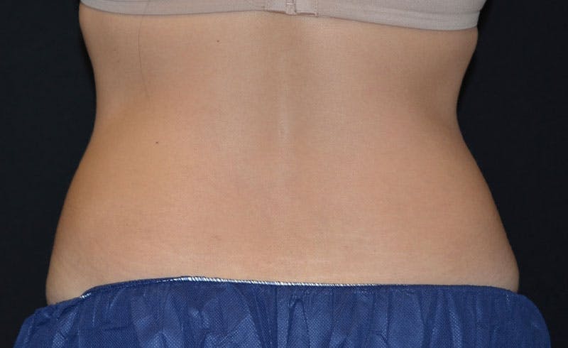 Female Love Handles Before & After Gallery - Patient 366564 - Image 2