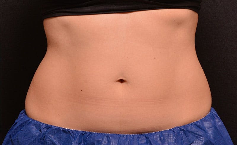 Female Love Handles Before & After Gallery - Patient 296433 - Image 1