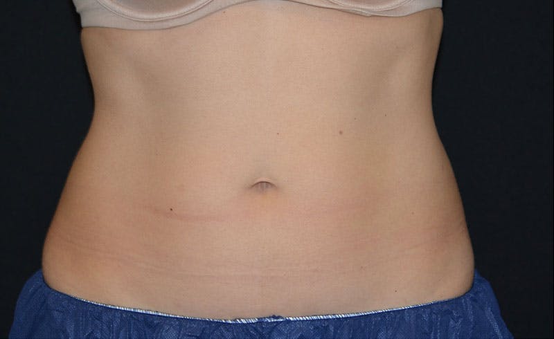Female Love Handles Before & After Gallery - Patient 296433 - Image 2