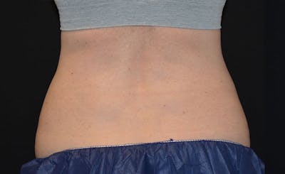 Female Love Handles Before & After Gallery - Patient 761247 - Image 1